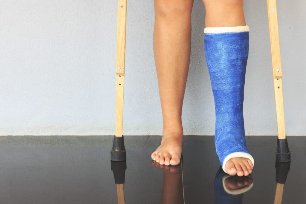 Broken Leg In A Plaster Cast | Workplace Injury Lawyers in New York City | Gash & Associates, P.C.
